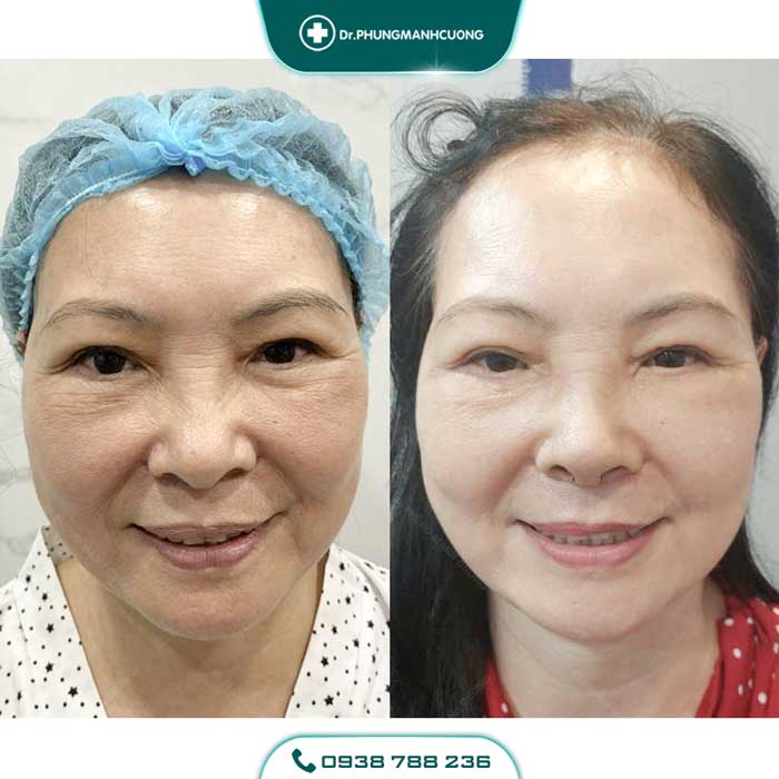 Cắt Mí (Eyelid) - Xây Dựng Diện Mạo "Bạc Tỷ" 20 cat mi 5