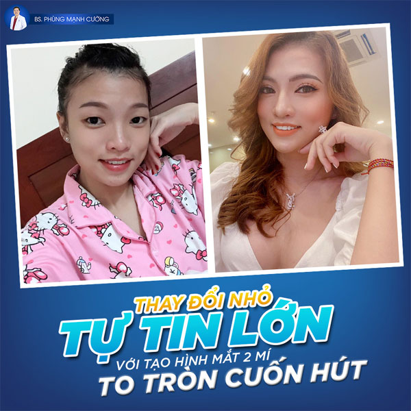 Chỉnh 2 Mắt Không Đều, 1 Bên To 1 Bên Nhỏ