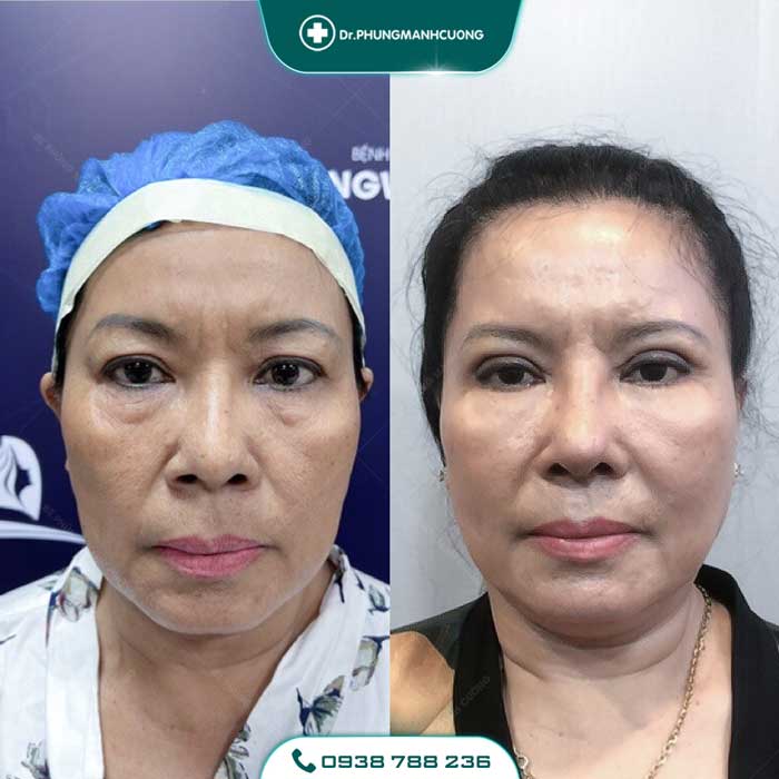 Cắt Mí (Eyelid) - Xây Dựng Diện Mạo "Bạc Tỷ" 21 cat mi 6