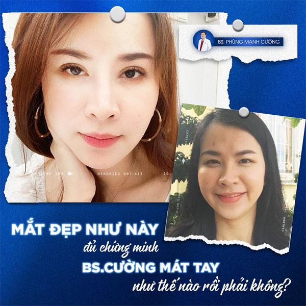 Cắt Mí Dưới (Perfect) - Giải Pháp Tất Yếu Cho Đôi Mắt Lão Hóa 13 Cắt Mí Dưới (Perfect) Giải Pháp Cho Đôi Mắt Có Vết "Thời Gian"