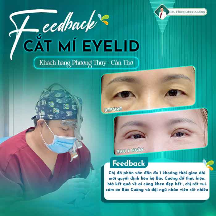 Cắt Mí (Eyelid) - Xây Dựng Diện Mạo "Bạc Tỷ" 30 cat mi eyelid 1