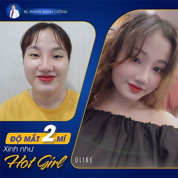 Cắt Mí (Hàn Quốc) Cho Đôi Mắt 2 Mí Đẹp Chuẩn Idol