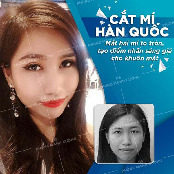 Cắt Mí (Hàn Quốc) - Kỹ Thuật Từ Xứ Sở Kim Chi