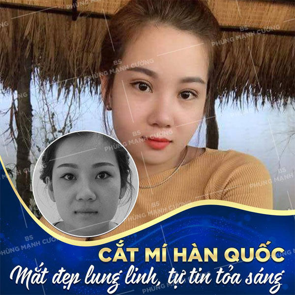 Cắt mí Hàn Quốc cho đôi mắt đẹp tự nhiên, rạng ngời