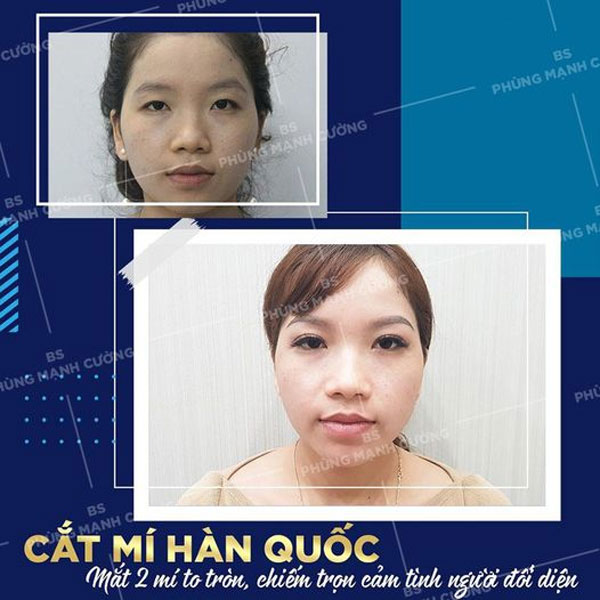 Cắt Mí (Hàn Quốc) Là Gì?