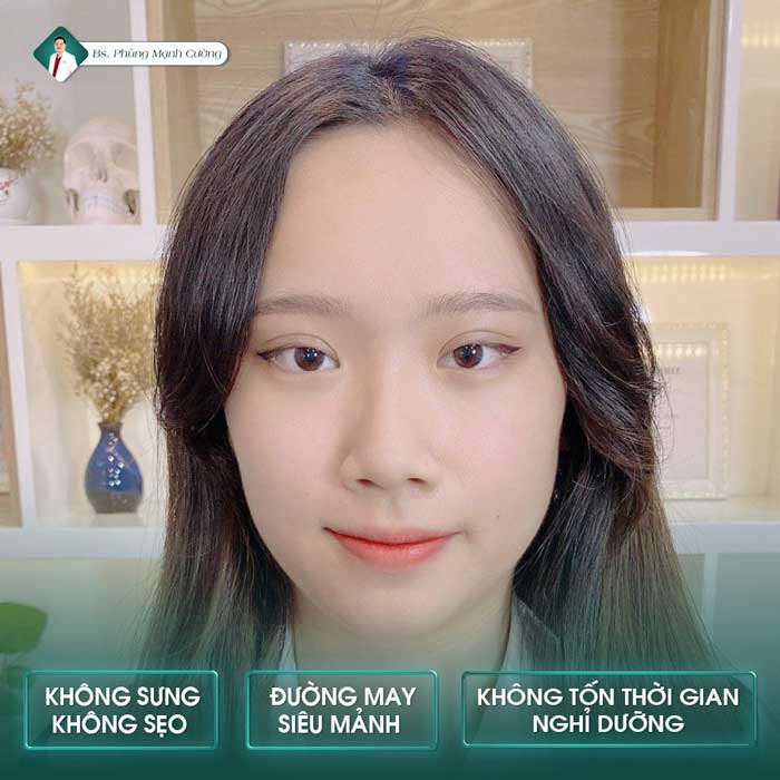 Những ưu điểm cắt mí Hàn Quốc tại BS Phùng Mạnh Cường