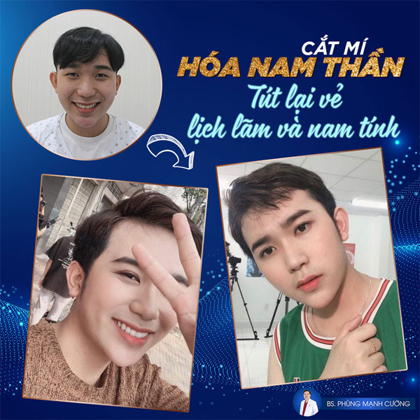 Chỉnh 2 Mắt Không Đều, Mang Lại Đôi Mắt Cân Xứng