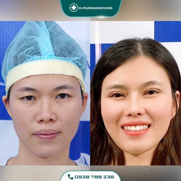 Cắt Mí (Eyelid) - Xây Dựng Diện Mạo "Bạc Tỷ" 29 cat mi nu15