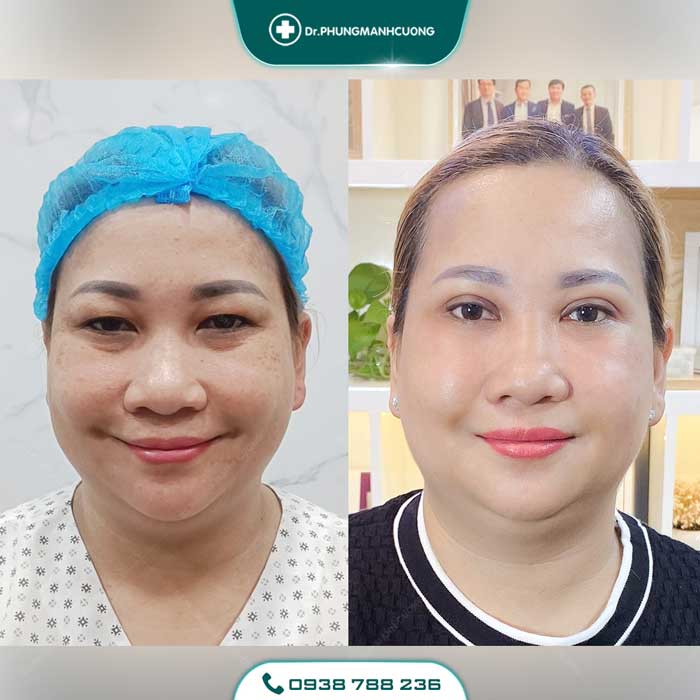 Cắt Mí (Eyelid) - Xây Dựng Diện Mạo "Bạc Tỷ" 24 cat mi nu18