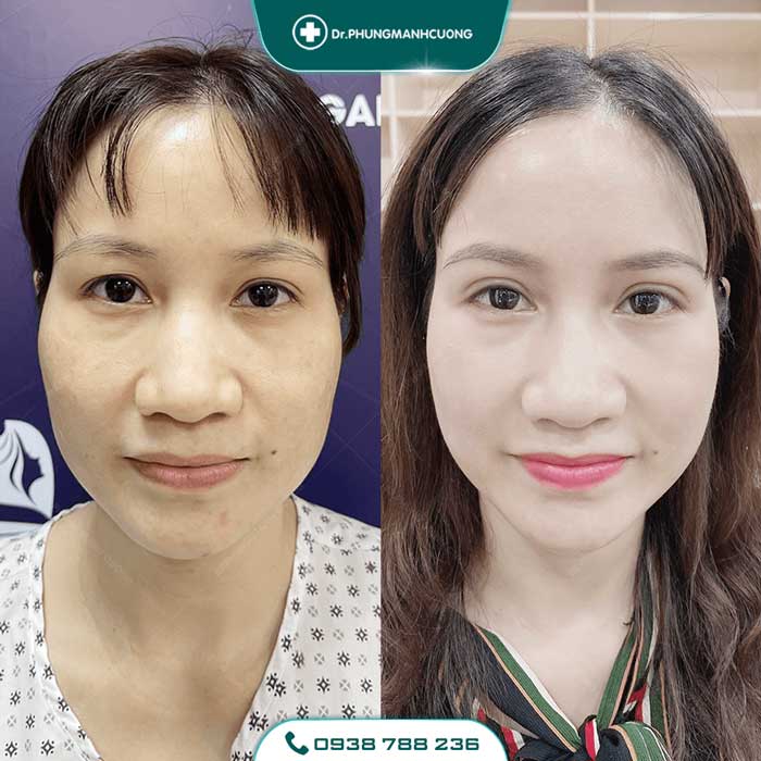 Cắt Mí (Eyelid) - Xây Dựng Diện Mạo "Bạc Tỷ" 25 cat mi nu19