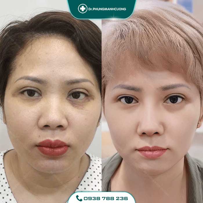 Cắt Mí (Eyelid) - Xây Dựng Diện Mạo "Bạc Tỷ" 26 cat mi nu21