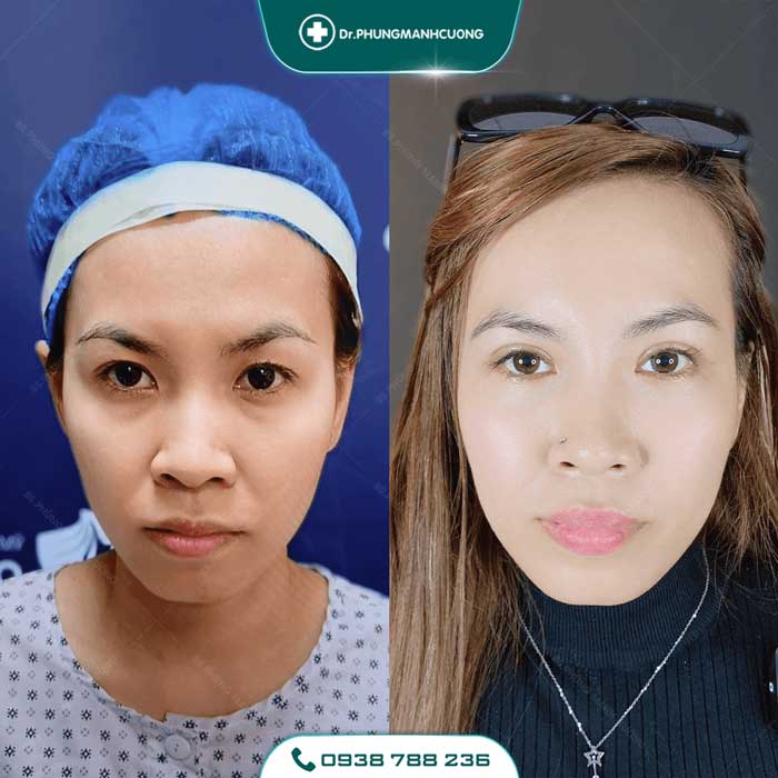 Cắt Mí (Eyelid) - Xây Dựng Diện Mạo "Bạc Tỷ" 27 cat mi nu22