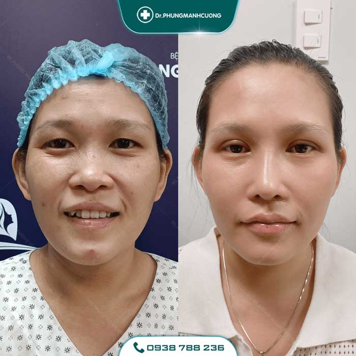 Cắt Mí (Eyelid) - Xây Dựng Diện Mạo "Bạc Tỷ" 28 cat mi nu23