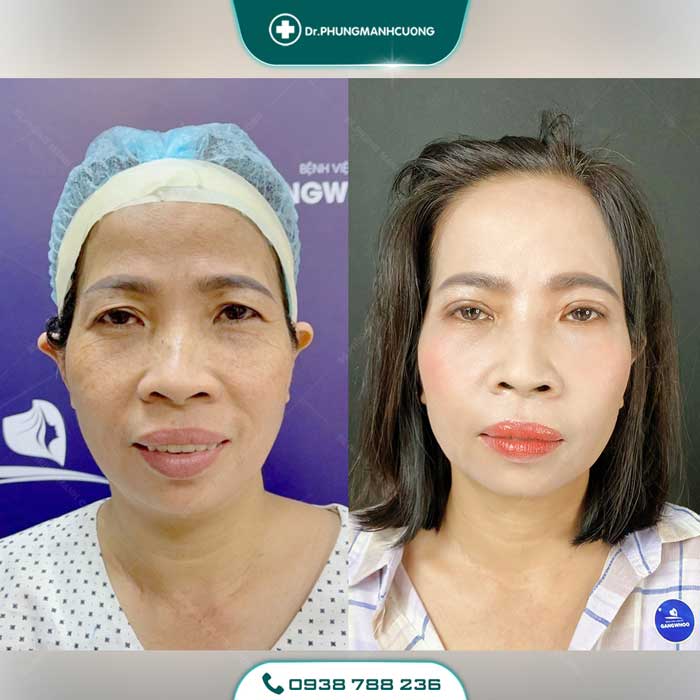 Cắt Mí (Eyelid) - Xây Dựng Diện Mạo "Bạc Tỷ" 23 cat mi nu26