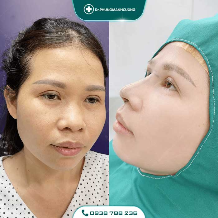 Cắt Mí (Eyelid) - Xây Dựng Diện Mạo "Bạc Tỷ" 22 cat mi nu28