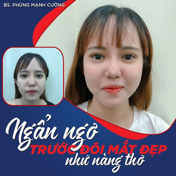 Cắt Mí Dưới (Perfect) - Giải Pháp Tất Yếu Cho Đôi Mắt Lão Hóa 18 Cắt Mí Perfect làm mí thêm sắc nét