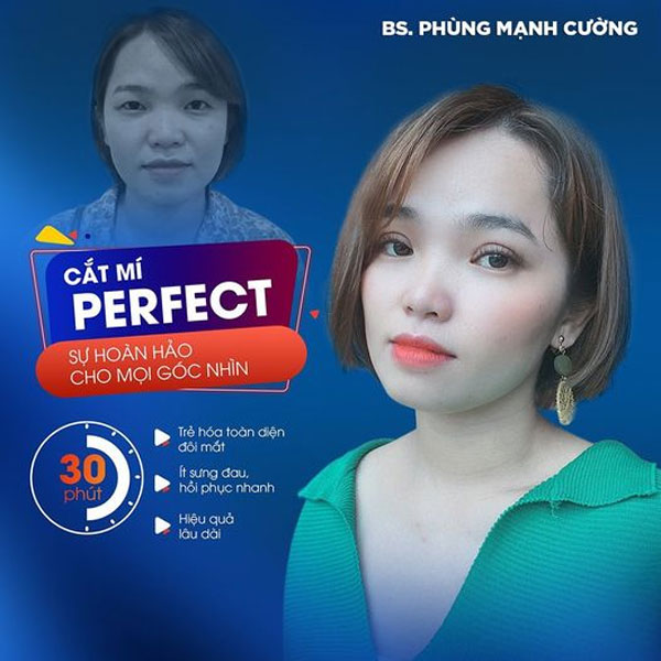 Cắt Mí Dưới (Perfect) - Giải Pháp Tất Yếu Cho Đôi Mắt Lão Hóa 22 Cắt Mí Perfect chuẩn phong thủy