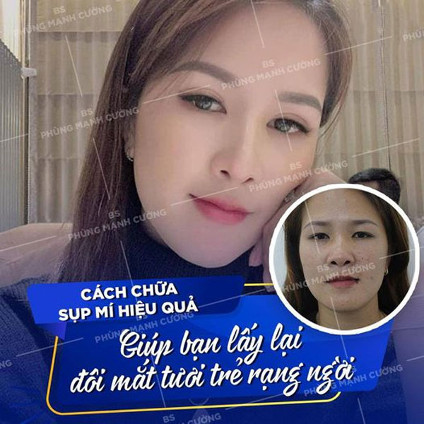 Cắt Mí Dưới (Perfect) - Giải Pháp Tất Yếu Cho Đôi Mắt Lão Hóa 21 Cắt Mí Perfect là giải pháp cho đôi mắt kém xinh