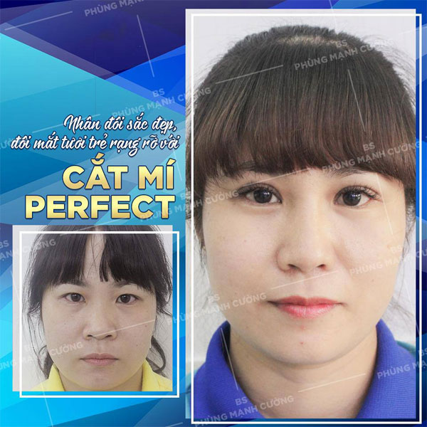 Cắt Mí Dưới (Perfect) - Giải Pháp Tất Yếu Cho Đôi Mắt Lão Hóa 17 Cắt Mí Perfect thổi hồn cho đôi mắt