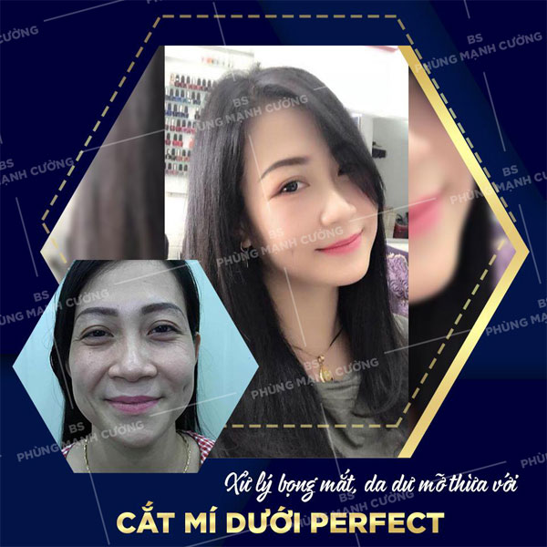 Cắt Mí Dưới (Perfect) - Giải Pháp Tất Yếu Cho Đôi Mắt Lão Hóa 20 Cắt Mí Perfect giúp mắt thêm to tròn