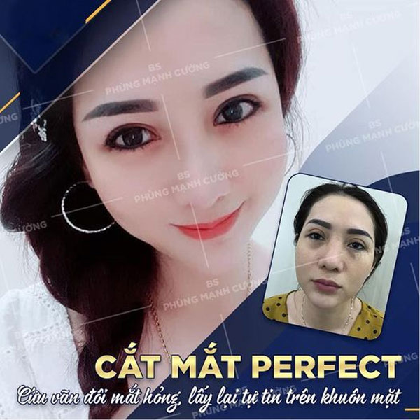 Cắt Mí Dưới (Perfect) - Giải Pháp Tất Yếu Cho Đôi Mắt Lão Hóa 19 Cắt Mí Perfect giúp mắt thêm hoàn thiện