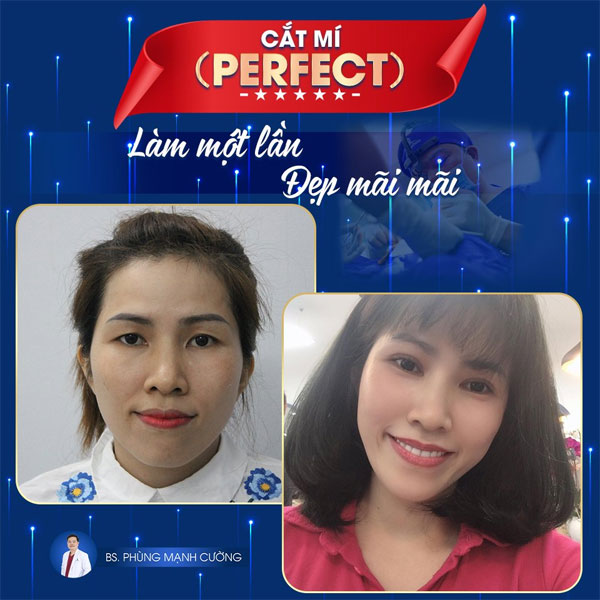 Cắt Mí Dưới (Perfect) - Giải Pháp Tất Yếu Cho Đôi Mắt Lão Hóa 23 cat mi perfect