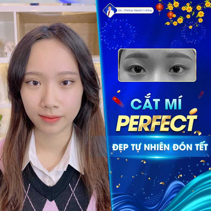 Cắt Mí Dưới (Perfect) - Giải Pháp Tất Yếu Cho Đôi Mắt Lão Hóa 16 cat mi perfect