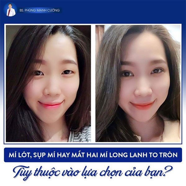 Cắt Mí (Hàn Quốc) An Toàn Tuyệt Đối