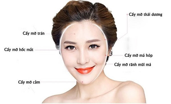 Các Vị Trí Có thể Cấy Mỡ Làm Đầy