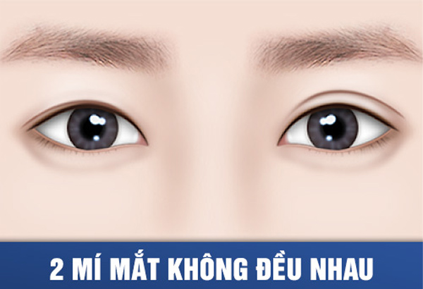 Chỉnh 2 Mắt Không Đều - 2 Mắt To Tròn Cân Xứng