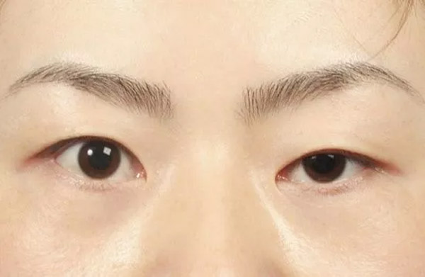 Chỉnh 2 Mắt Không Đều, Bên To Bên Nhỏ