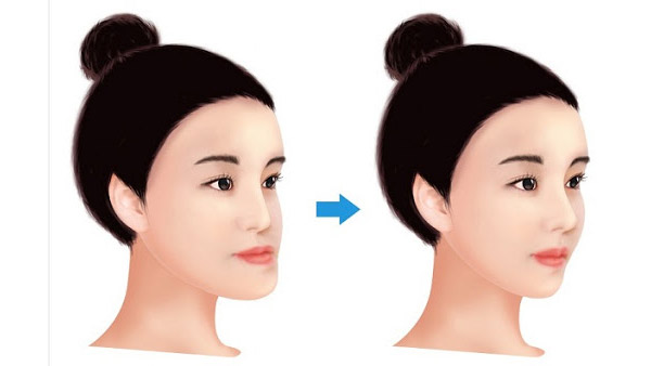 Lưu Ý Trước Khi Chỉnh Hàm Hô Móm