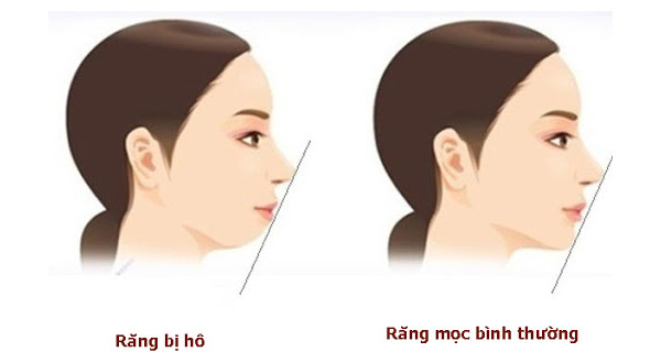 Chỉnh Hàm Hô Móm Có Được Gì Không?