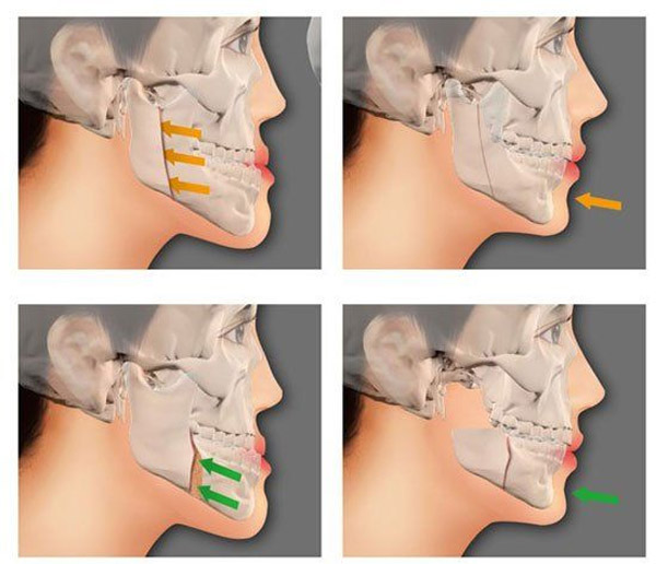 Để Chỉnh Hàm Hô Móm Thì Cần Xác Định Nguyên Nhân