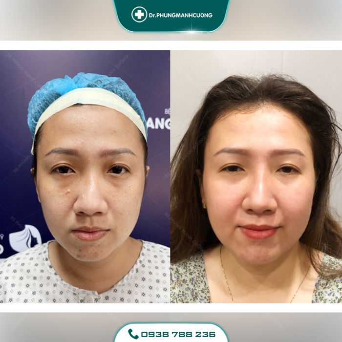 Chỉnh Dị Tật Mũi - Giải Pháp "Cứu Cánh" Cho Mũi Biến Dạng 18 chinh mui di tat 1 1