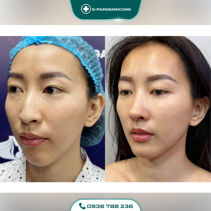 Chỉnh Dị Tật Mũi - Giải Pháp "Cứu Cánh" Cho Mũi Biến Dạng 17 chinh mui di tat 2