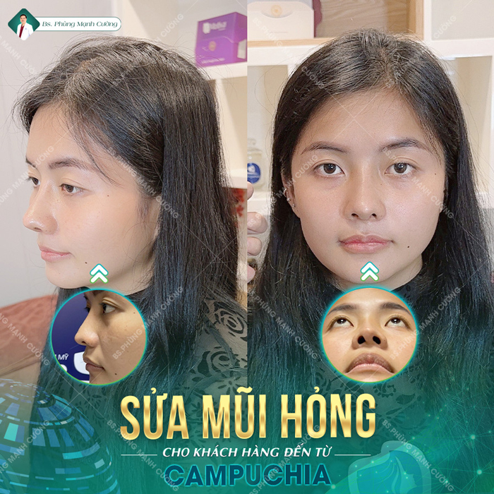 Chỉnh Dị Tật Mũi - Giải Pháp "Cứu Cánh" Cho Mũi Biến Dạng 11 Chỉnh Dị Tật Mũi - Cánh mũi bị mất 1 phần