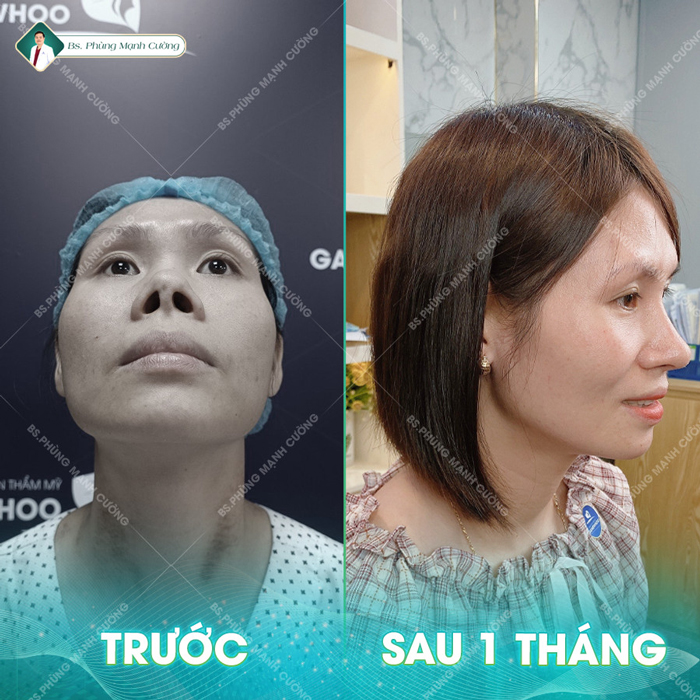 Chỉnh Dị Tật Mũi - Giải Pháp "Cứu Cánh" Cho Mũi Biến Dạng 13 Một vài dáng mũi dị dạng cần Chỉnh Dị Tật Mũi