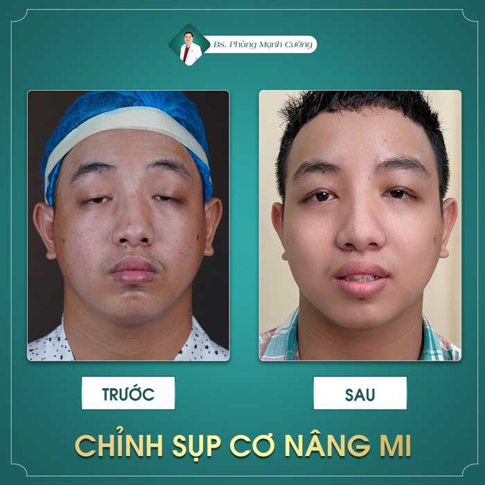 Hiện tại có 2 phương pháp chỉnh sụp cơ nâng mi