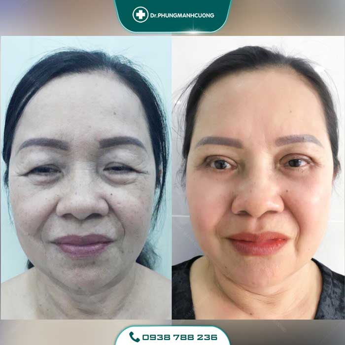 chinh sup mi bam sinh 1 2