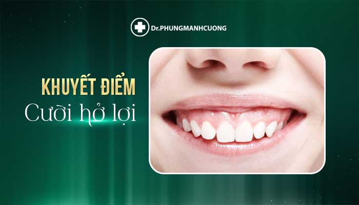 Khuyết điểm cười hở lợi