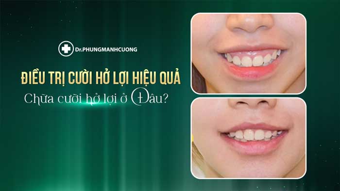 Chọn địa chỉ điều trị cười hở lợi uy tín sẽ giúp tăng sự an toàn