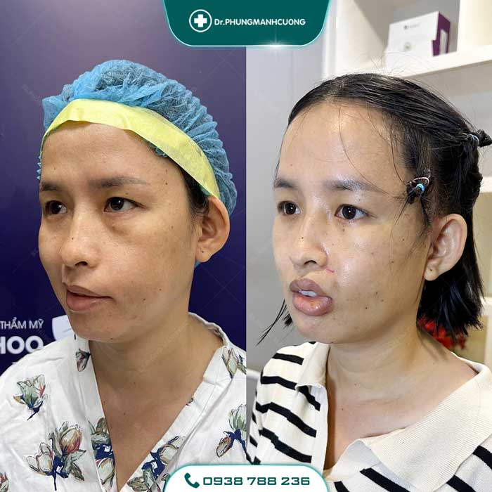 Điều Trị Liệt Mặt Ngoại Biên An Toàn, Hiệu Quả 100% 32 dieu tri liet mat 1 1