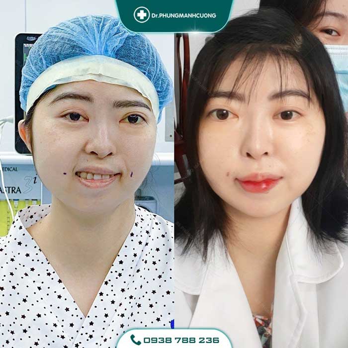 Điều Trị Liệt Mặt Ngoại Biên An Toàn, Hiệu Quả 100% 31 dieu tri liet mat 1