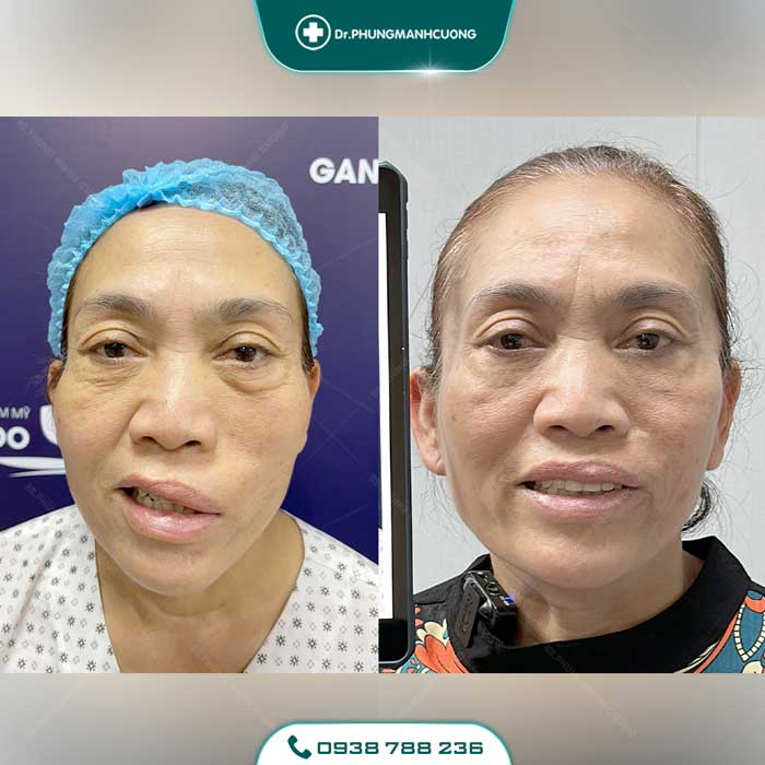 Điều Trị Liệt Mặt Ngoại Biên An Toàn, Hiệu Quả 100% 33 dieu tri liet mat 2