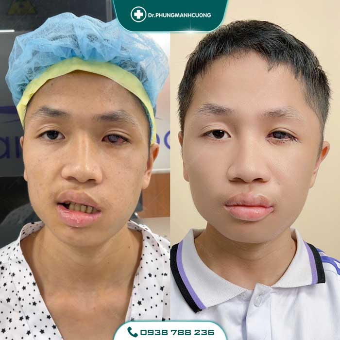 Điều Trị Liệt Mặt Ngoại Biên An Toàn, Hiệu Quả 100% 34 dieu tri liet mat 4