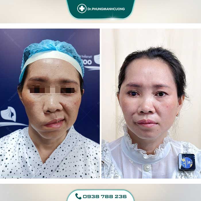 Điều Trị Liệt Mặt Ngoại Biên An Toàn, Hiệu Quả 100% 35 dieu tri liet mat 5