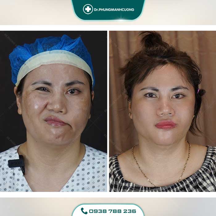 Điều Trị Liệt Mặt Ngoại Biên An Toàn, Hiệu Quả 100% 36 dieu tri liet mat 6