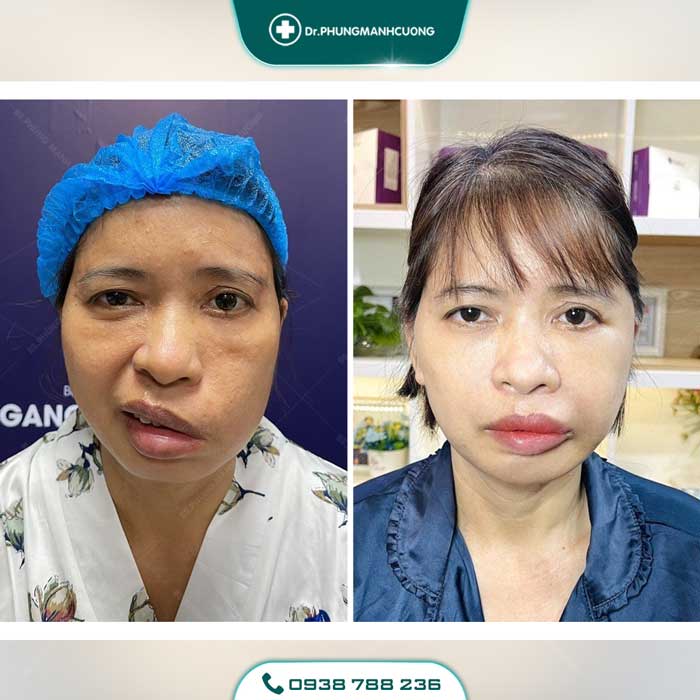 Điều Trị Liệt Mặt Ngoại Biên An Toàn, Hiệu Quả 100% 37 dieu tri liet mat 7