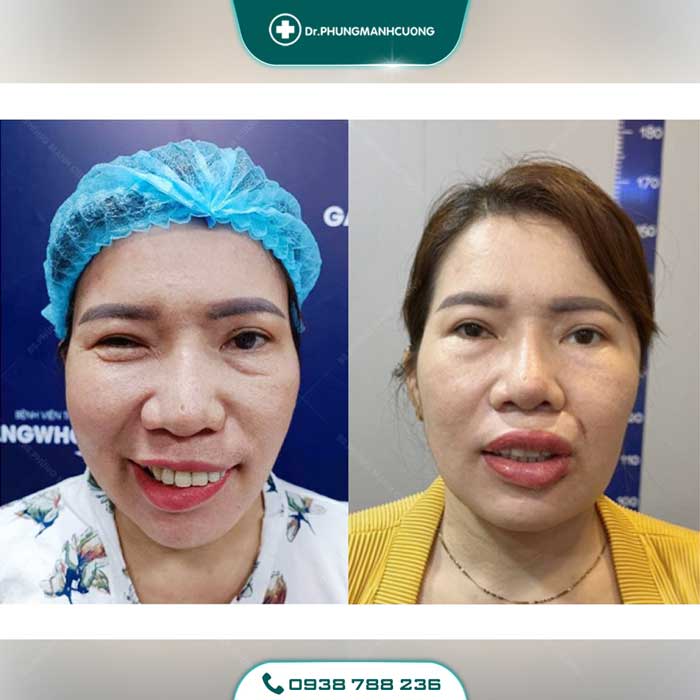 Điều Trị Liệt Mặt Ngoại Biên An Toàn, Hiệu Quả 100% 38 dieu tri liet mat 8